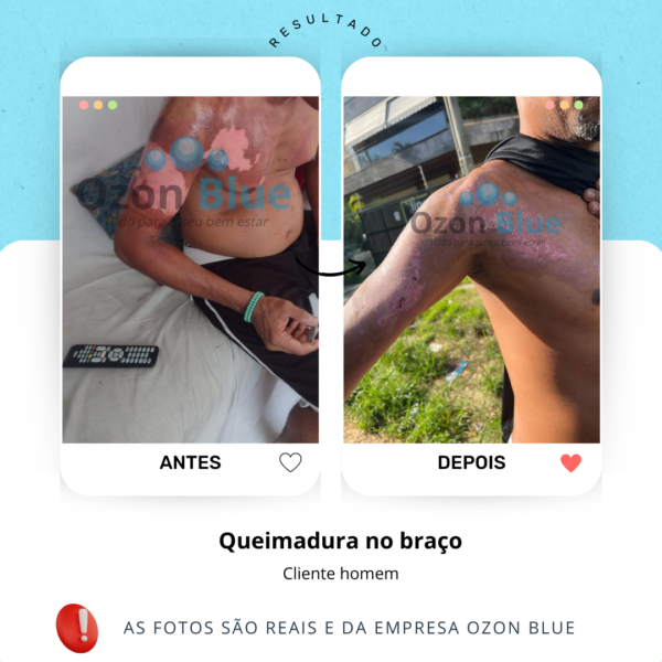 Óleo de Girassol Ozonizado 3