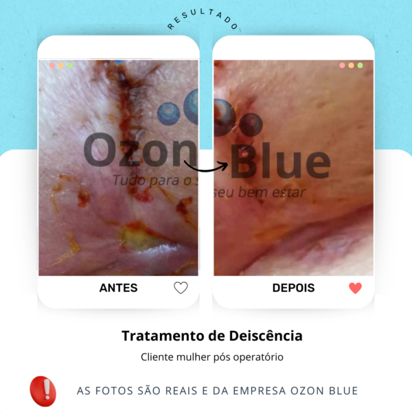 Óleo de Girassol Ozonizado 3